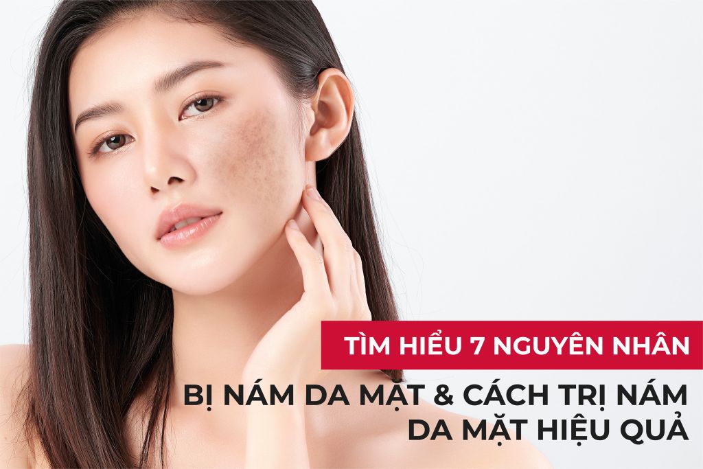 Tìm hiểu 7 nguyên nhân bị nám da mặt và cách trị nám da mặt hiệu quả
