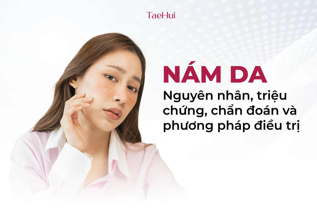 NÁM DA: Nguyên nhân, triệu chứng, chẩn đoán và phương pháp điều trị