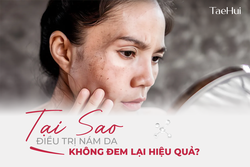 Tại sao điều trị nám da mãi không đem lại hiệu quả?