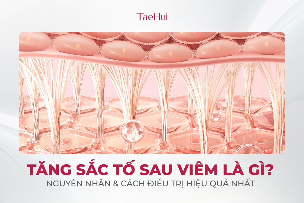 Tăng sắc tố sau viêm là gì? Nguyên nhân & cách điều trị hiệu quả nhất