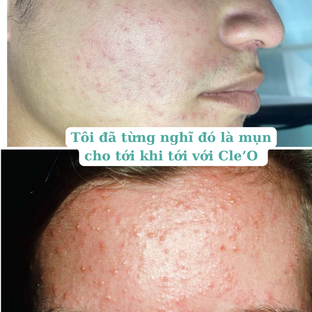 Phân biệt giữa mụn ẩn và mụn nấm men. Cách điều trị hiệu quả. CLEOHOUSE