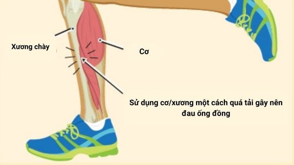 đau ống đồng khi chạy bộ