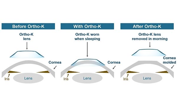 cơ chế chỉnh hình giác mạc của Ortho-K