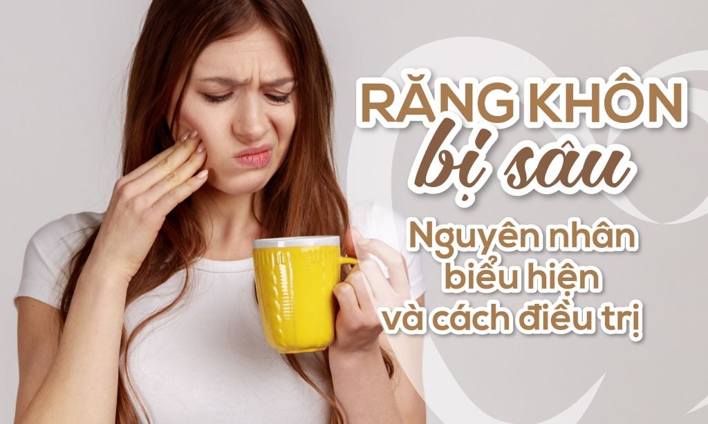 Răng khôn bị sâu: Nguyên nhân, biểu hiện và cách điều trị