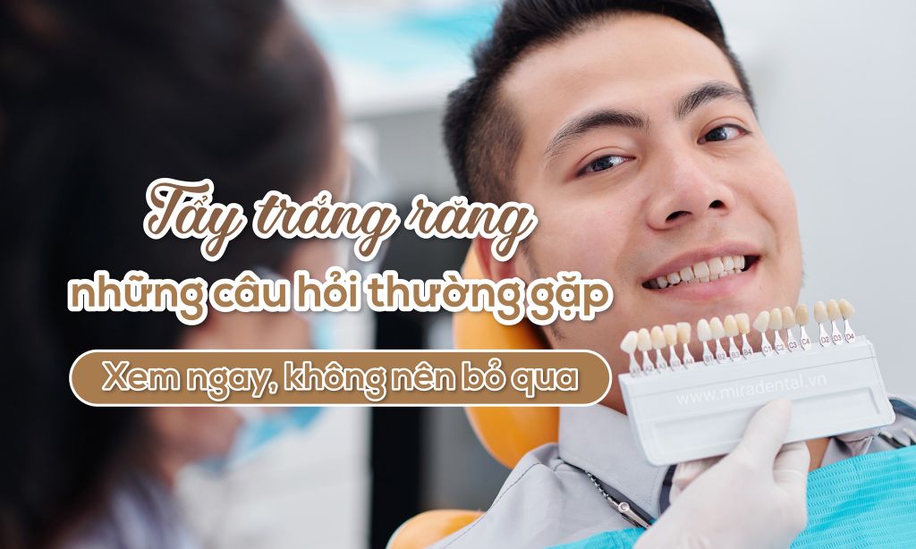 Những câu hỏi về tẩy trắng răng thường gặp, bạn không thể bỏ qua