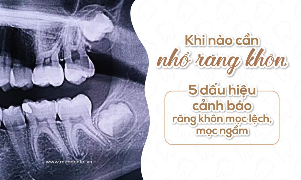 Khi nào cần nhổ răng khôn? 5 dấu hiệu cảnh báo răng khôn mọc lệch, mọc ngầm