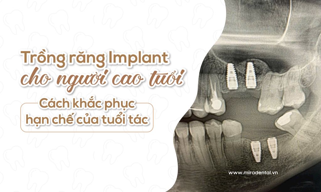 Trồng răng Implant cho người cao tuổi: Cách khắc phục hạn chế của tuổi tác