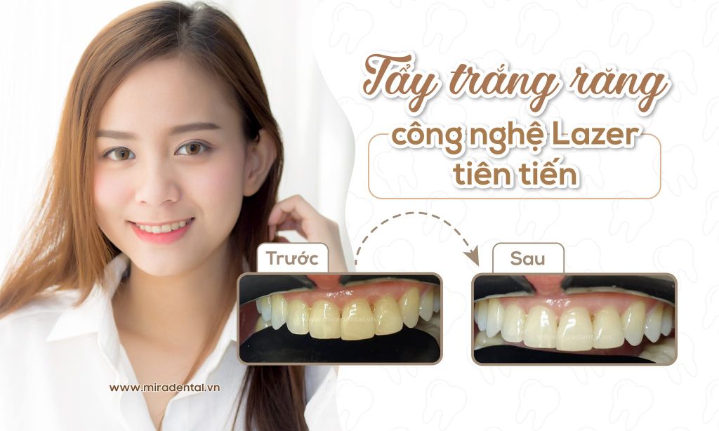Công Nghệ Tẩy Trắng Răng Hiện Đại Và An Toàn Bằng Lazer
