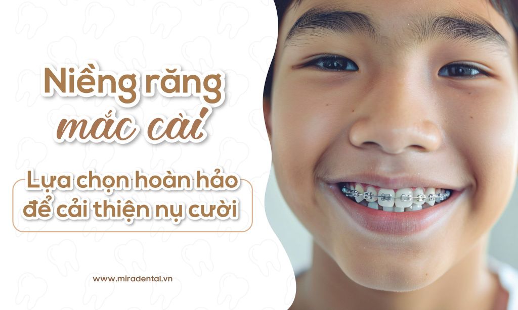Niềng răng mắc cài: Lựa chọn hoàn hảo để cải thiện nụ cười