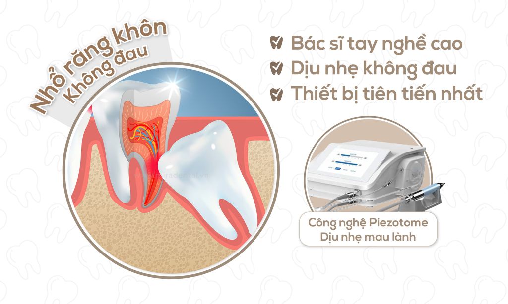 Nhổ Răng Không Đau Với Công Nghệ Piezotome Tại Nha Khoa Mira – Dịch Vụ Chuyên Nghiệp, An Toàn