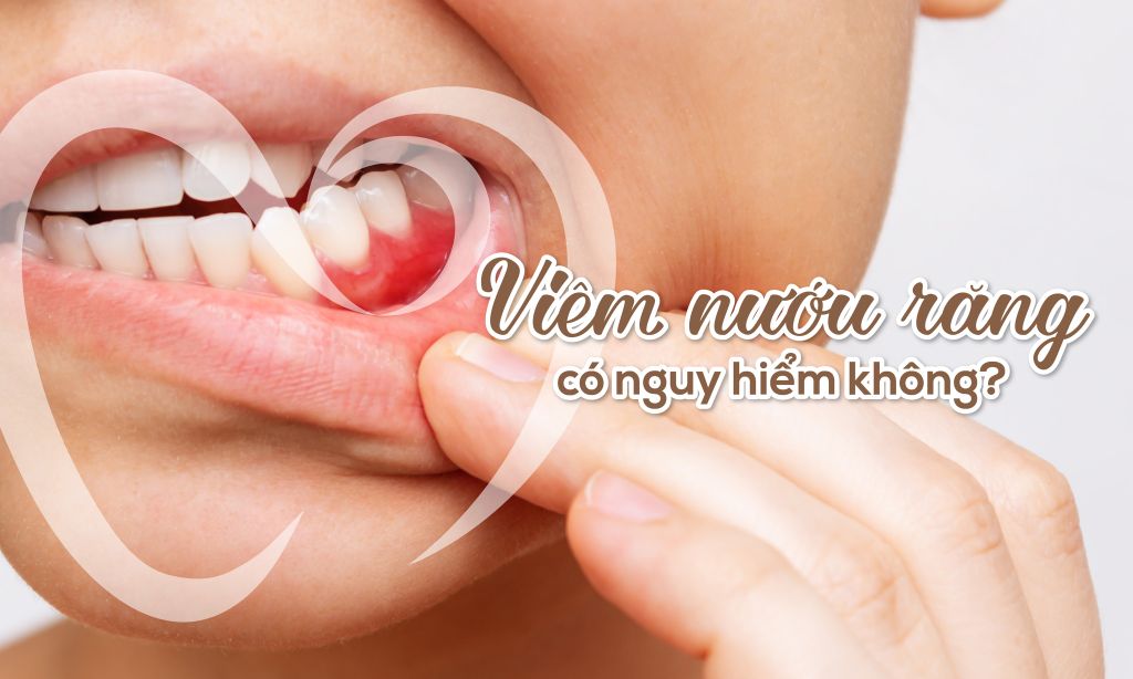 Viêm nướu răng có nguy hiểm không?