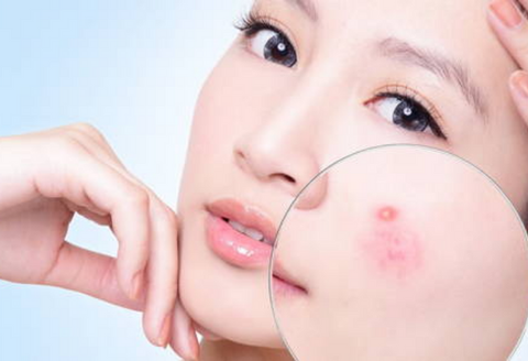 Hướng dẫn chăm sóc da mặt sau khi nặn mụn