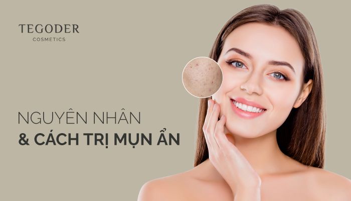 Nguyên nhân và cách trị mụn ẩn hiệu quả, không phải ai cũng biết