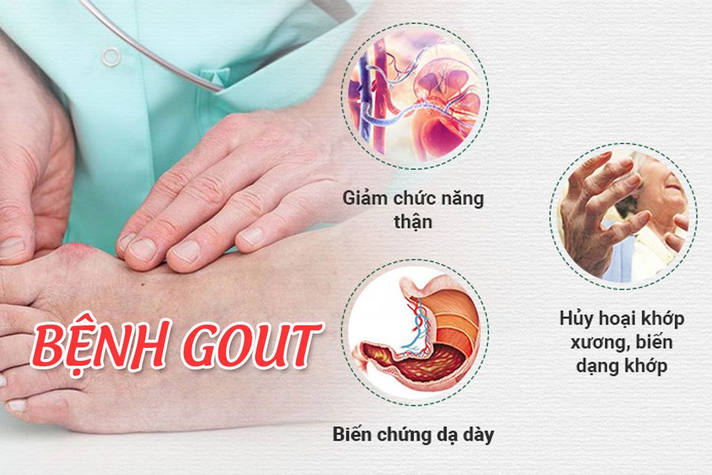 Nhận biết sớm dấu hiệu bệnh Gout giúp điều trị hiệu quả hơn