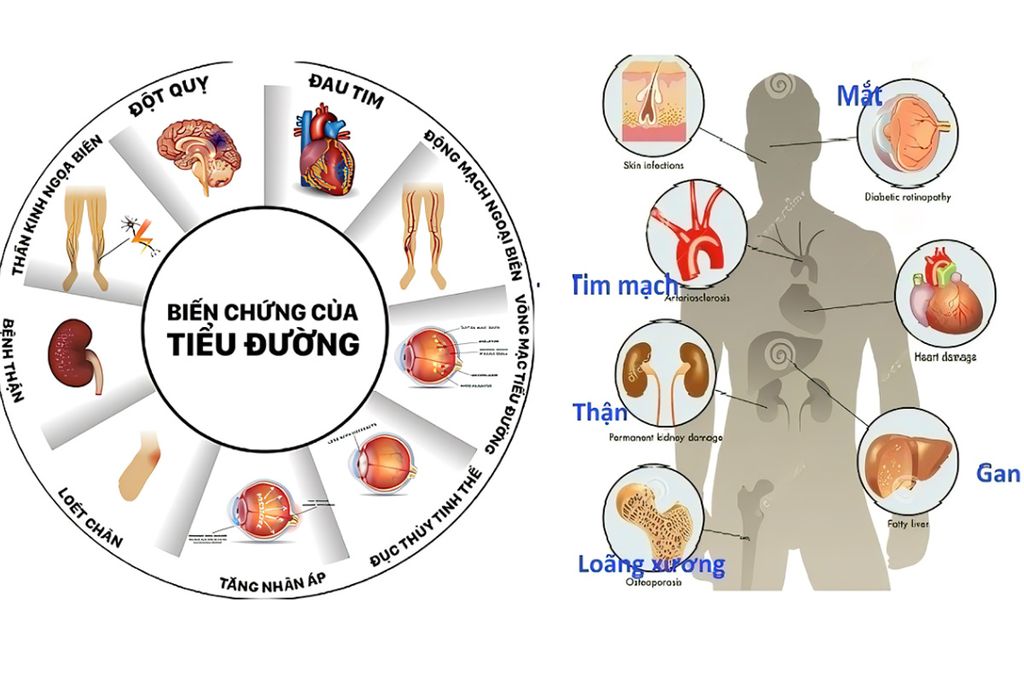Biến chứng của bệnh đái tháo đường