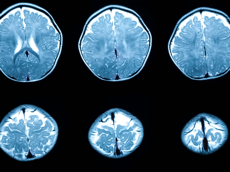 bệnh thoái hóa chất trắng nên ăn gì