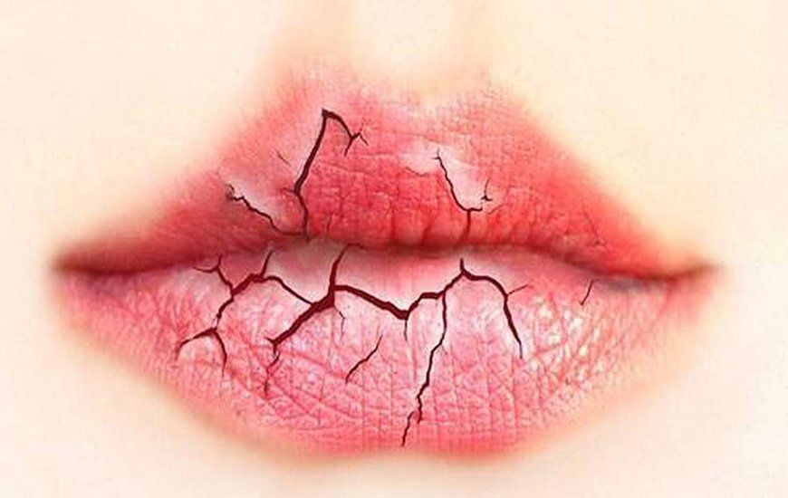 Khô Miệng – Vấn Đề Nhỏ Nhưng Hậu Quả Lớn, Bạn Có Đang Gặp Phải?