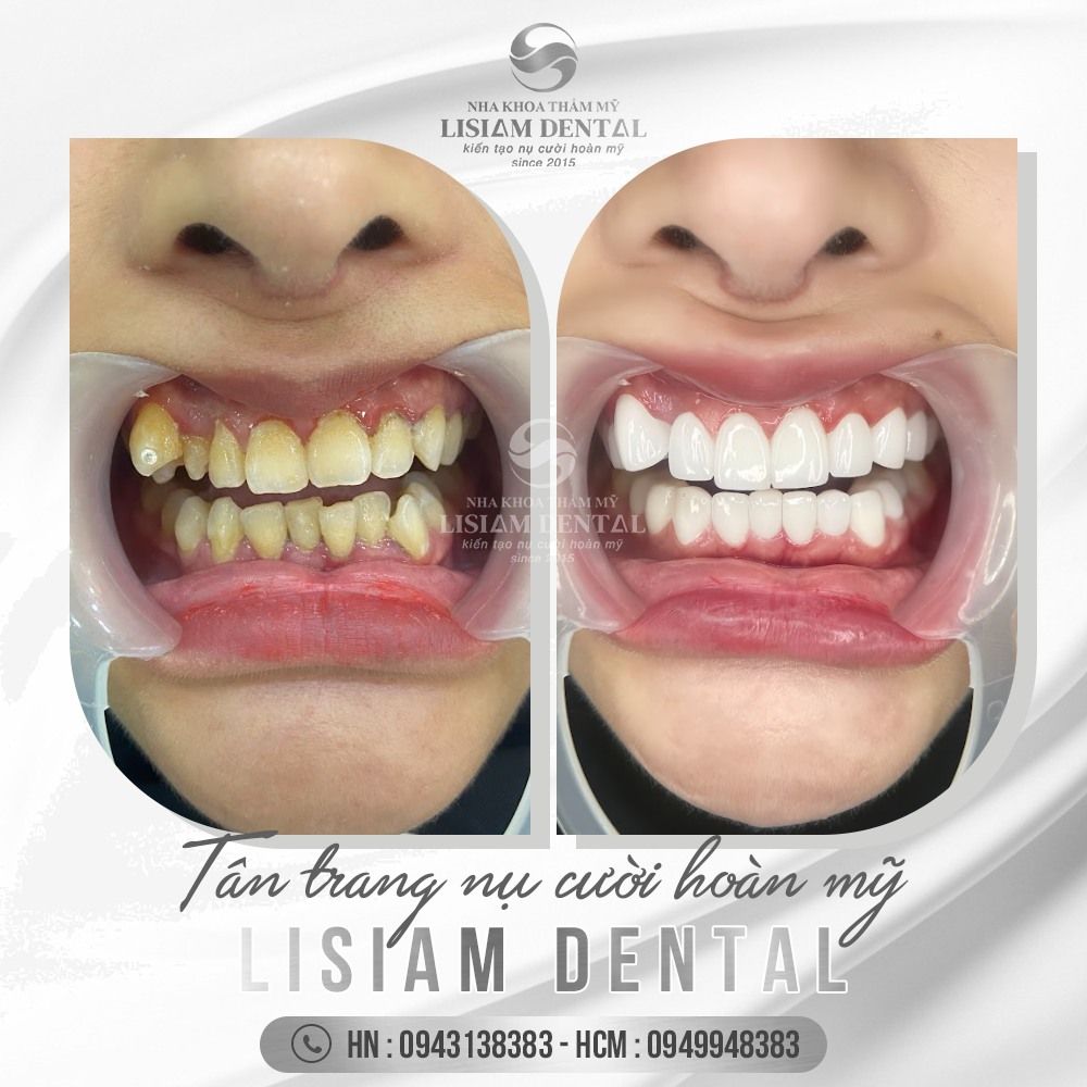 Bọc răng sứ tại LISIAM - Thẩm mỹ, bền đẹp