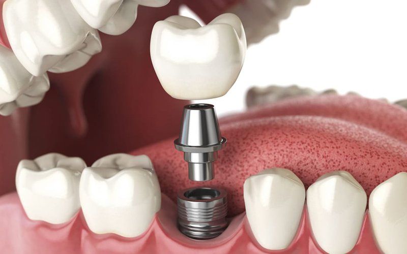 Cấy Ghép Implant – Giải Pháp Tối Ưu Cho Răng Mất