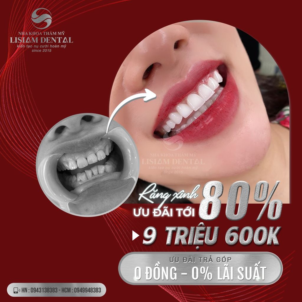 BỌC RĂNG SỨ THẨM MỸ - MANG NỤ CƯỜI XINH ĐẾN BẠN