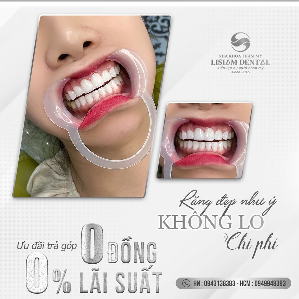 RĂNG ĐẸP NHƯ Ý - KHÔNG LO CHI PHÍ