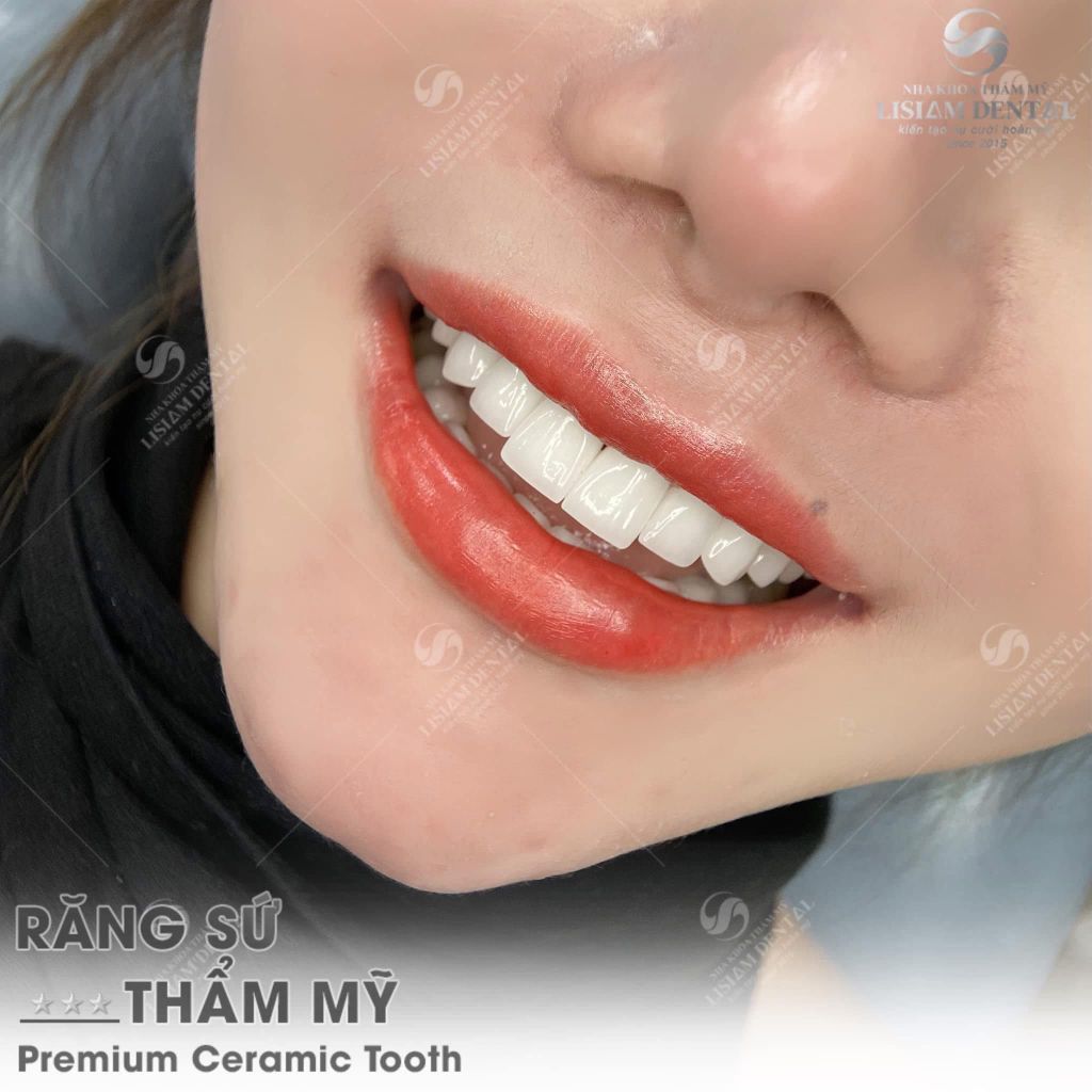 Sườn Răng Sứ – Yếu Tố Cốt Lõi Cho Độ Bền Và Chức Năng Hoàn Hảo