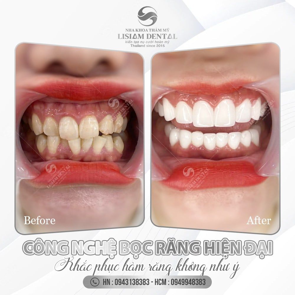 Công nghệ bọc răng sứ hiện đại - Khắc phục hàm răng như ý