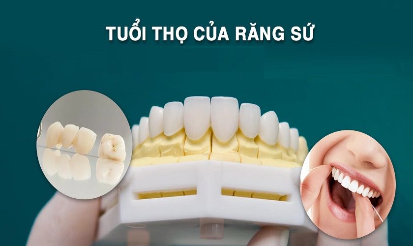 Tuổi Thọ Răng Sứ – Bí Quyết Để Giữ Được Hàng Chục Năm