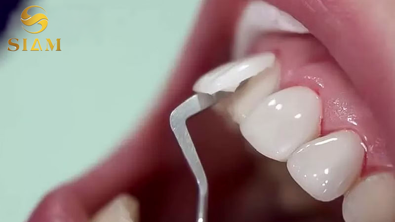 Bọc Răng Sứ Rồi Có Tháo Ra Được Không? Tìm Hiểu Ngay!