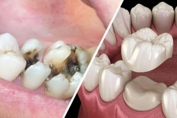 Bọc Răng Sứ – Giải Pháp Hiệu Quả Cho Răng Sâu
