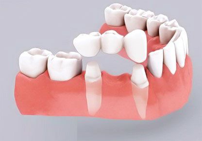 Cầu Răng Sứ – Quy Trình Và Lưu Ý Để Phục Hồi Nụ Cười Hoàn Hảo