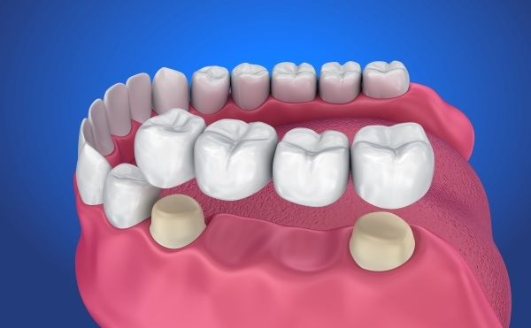 Cầu Răng Sứ – Giải Pháp Hiệu Quả Cho Răng Mất