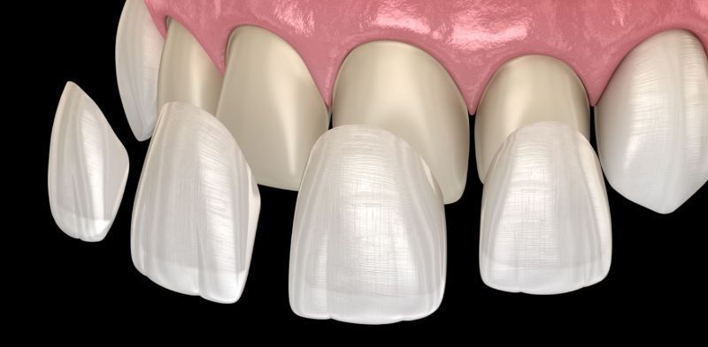 Răng Thưa Làm Bạn Tự Ti? Dán Sứ Veneer Là Giải Pháp Hoàn Hảo!