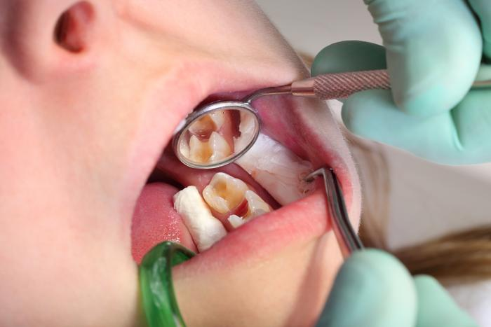 Khi Nào Cần Đưa Con Đến Nha Sĩ Vì Viêm Tủy Răng Sữa?