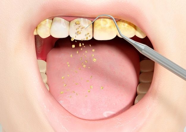 Những lợi ích của việc cạo vôi răng