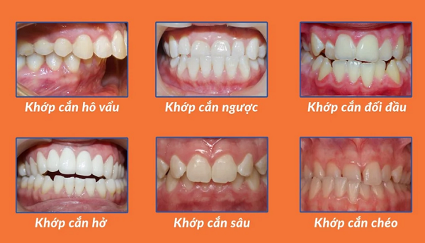 Khớp Cắn Tiêu Chuẩn Là Gì? Tất Cả Những Gì Bạn Cần Biết