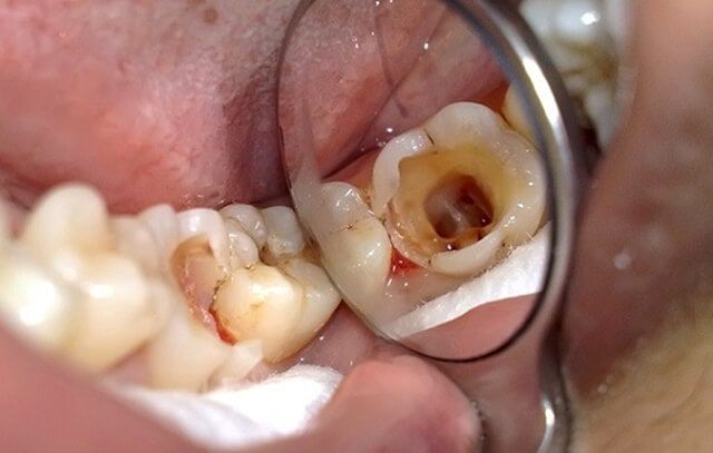 Sau Khi Điều Trị Răng Sâu Nên Làm Gì Để Không Bị Gãy Mất Chân Răng Đó?