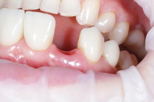 Mất Răng – Không Chỉ Là Thẩm Mỹ, Mà Còn Ảnh Hưởng Sức Khỏe