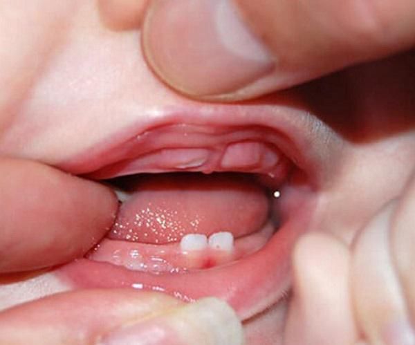 Viêm Nướu Ở Trẻ Nhỏ: Nguyên Nhân, Triệu Chứng Và Cách Phòng Ngừa