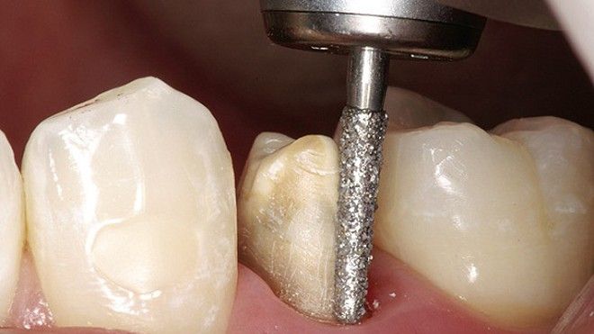 Mài Răng Khi Bọc Sứ Có Đáng Lo? Giải Đáp Từ Nha Khoa Siam Dental