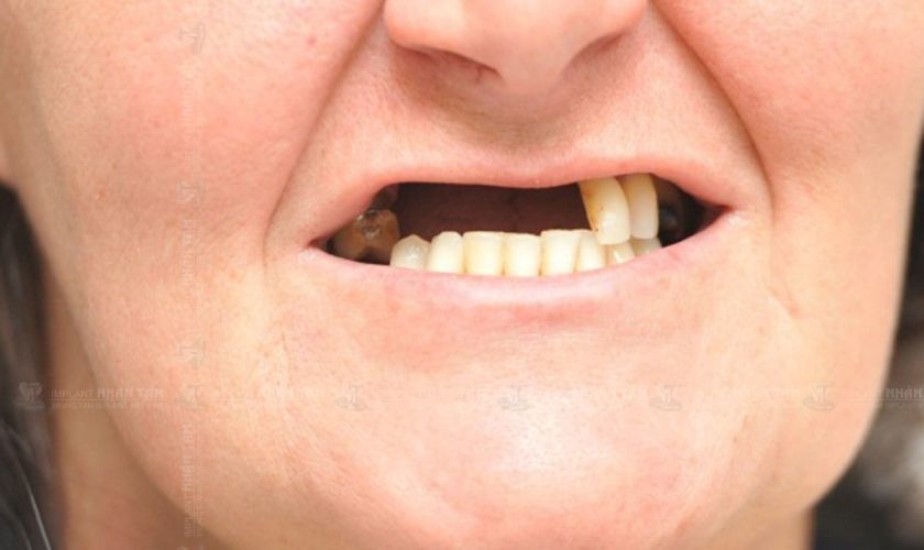 Răng Mất Lâu Ngày Có Phục Hình Được Không? Giải Đáp Từ Siam Dental
