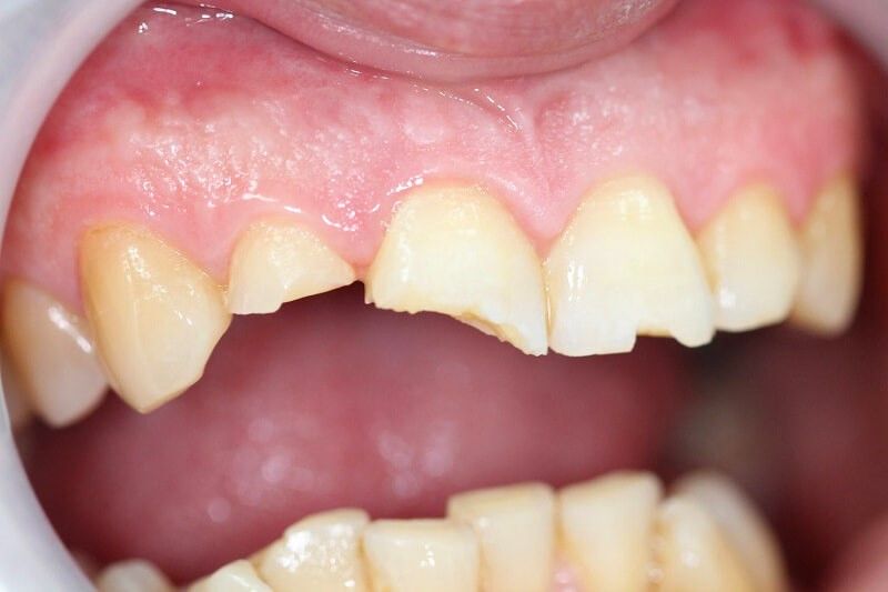 Các Phương Pháp Phục Hình Răng Bị Gãy Hiệu Quả