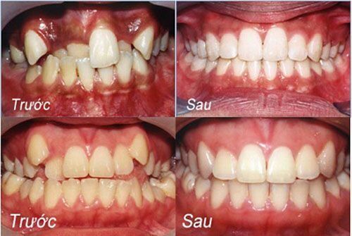 Răng Khấp Khểnh Có Bọc Răng Sứ Được Không?
