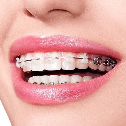 Niềng Răng Sau Khi Bọc Răng Sứ – Có Khả Thi Không? Giải Đáp Từ Nha Khoa Siam Dental
