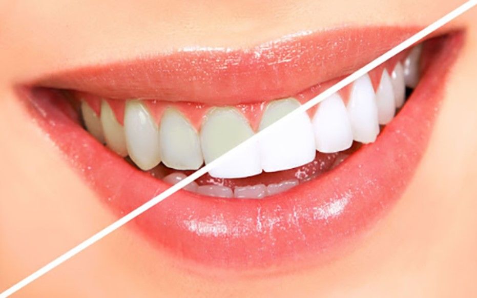 Phục Hình Răng Gãy Bằng Răng Sứ – Giải Pháp Hoàn Hảo Tại Nha Khoa Siam Dental