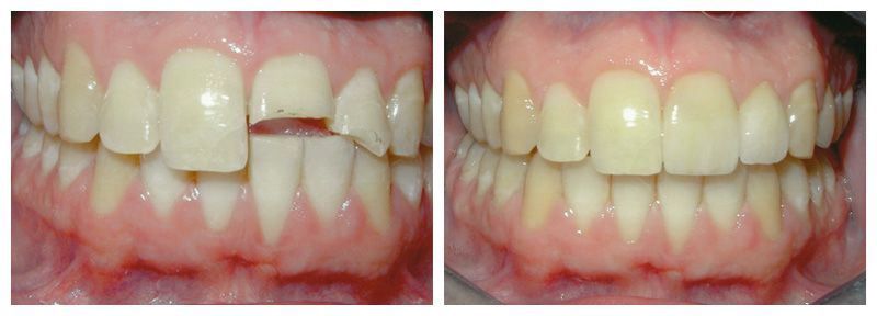 Răng Bị Mẻ Để Lâu Có Sao Không?