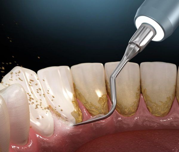 Nguy Hại Của Cao Răng: Bảo Vệ Sức Khỏe Răng Miệng Toàn Diện