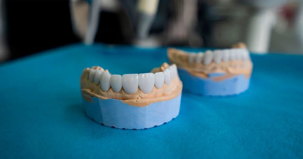 Răng Sứ Theo Dấu Răng Cá Nhân – Không Chỉ Là Thẩm Mỹ Mà Còn Là Sức Khỏe