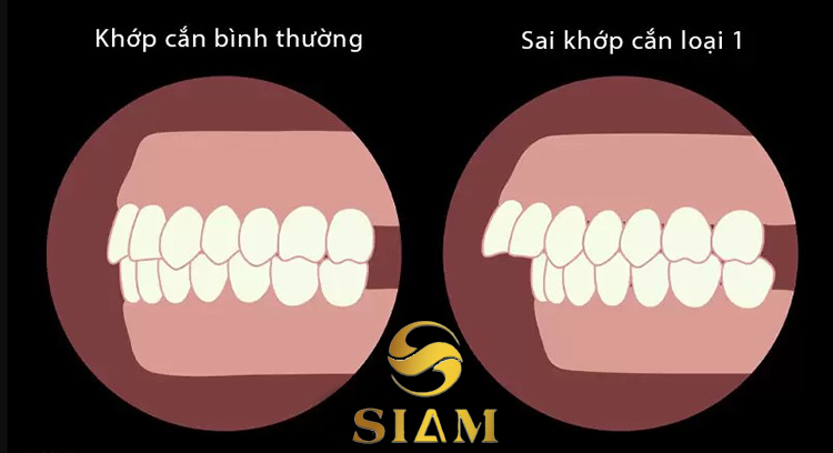 Sai Khớp Cắn Là Gì? Tìm Hiểu Và Giải Pháp Hiệu Quả