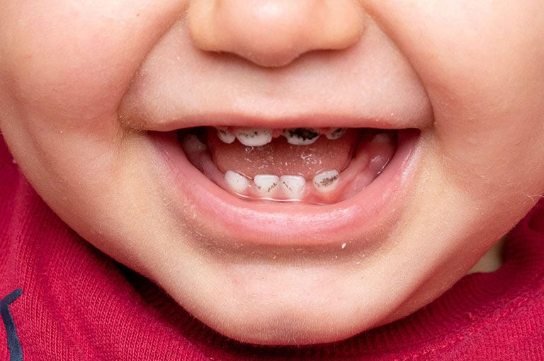 Răng Sữa Bị Sâu Và Ảnh Hưởng Đến Tủy Răng – Hành Trang Bảo Vệ Nụ Cười Bé Yêu